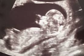 Boy Or Girl The Difficulties Of Early Gender Prediction Your Pregnancy Matters Ut Southwestern Medical Center
