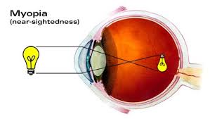 Image result for Refractive Error
