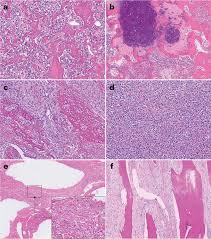Image result for Osteosarcoma