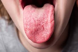 Image result for brown tongue symptoms