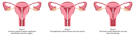 Maybe you would like to learn more about one of these? Mirena Insertion What To Expect With Mirena Iud Placement