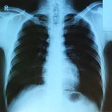 _____ is the process of using electronic transfer of images and other information for consultation and.or insurance purposes in dentistry. X Ray Wikipedia