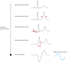 Ecg Changes Due To Electrolyte Imbalance Disorder Ecg