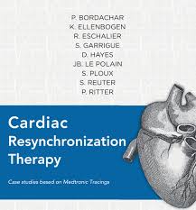 Image result for Cardiac Resynchronization Therapy