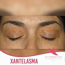 Image result for xantelasma
