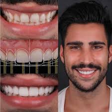Smile Design
