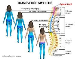 The segment of the spinal cord that has inflammation or damage determines the symptoms a person has. Transverse Myelitis