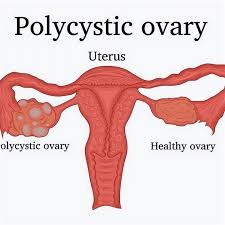 • serves as canal for menstrual fluid • forms the inferior part of birth canal. She Found Relief From Polycystic Ovarian Syndrome