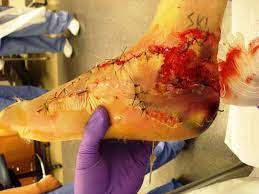 Degloving Injury The Foot And Ankle Online Journal