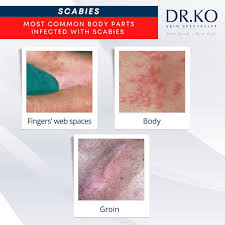 Image result for scabies in the groin area