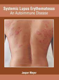 Some people have only a few mild symptoms and others have. Systemic Lupus Erythematosus An Autoimmune Disease Meyer Jasper Amazon De Bucher