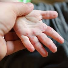 Babies And Skin Allergies Eczema Triggers Skin Allergies Baby Eczema