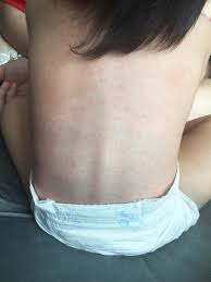 Use a moisturizing cream (such as eucerin) once or twice daily. The Devil Is Roseola And How I Survived It Jo Lauren