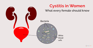 Image result for Recurrent Cystitis