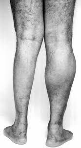 Calf Hypertrophy Following Paralytic Poliomyelitis Postgraduate Medical Journal
