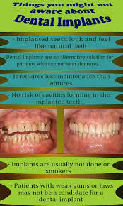 Curious To Learn More About Dental Implants Please Click On The Image Dental Implants Implantdentistry Den Dental Implants Dental Dental Implant Procedure