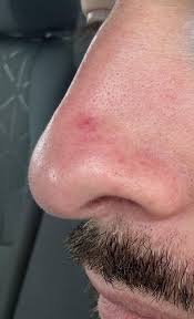 Image result for skin cancer on nose pimple