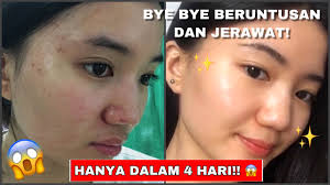 Menghilangkan jerawat tidak melulu menggunakan produk kimia. Cara Menghilangkan Jerawat Dan Beruntusan Dalam 4 Hari Youtube