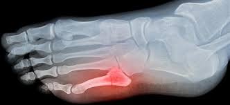 Image result for Foot XRay