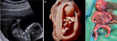 Amniotic Band Syndrome