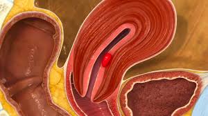 The process used to find out if and how far the cancer has spread beyond the uterus is called staging. Endometrial Cancer Willis Knighton Health System