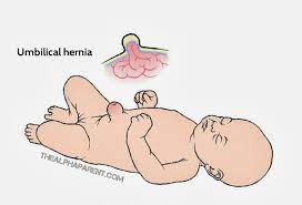 Selamat datang di situs penjualan obat herbal alami online terbesar, terbaik dan terpercaya di indonesia. Hernia Pada Bayi Mengenal Jenis Dan Gejalanya Popmama Com