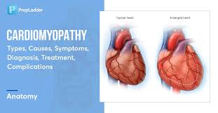 Image result for Cardiomyopathy