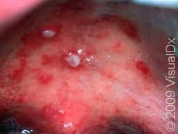 Image result for Hand foot and mouth disease HFMD roof of mouth