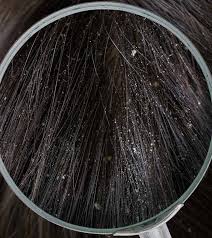 You may need to try more than one shampoo to find the hair care. Different Types Of Dandruff And How To Stop Them