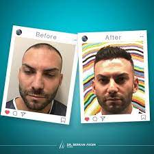 Before After Hair Transplantation Sac Ekimi Oncesi Ve Sonrasi Sacekimi Sacekimiuzmani Sacekimmerkezi Sacekimioncesi Sacekimisonrasi Drserkanay Sac Ekim