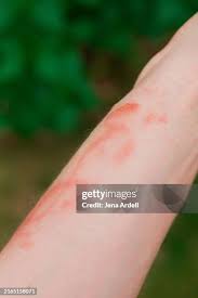 Image result for Rhus Dermatitis