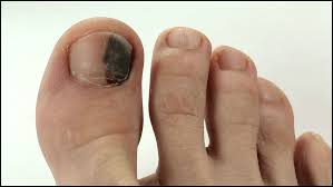 If you tend to walk around barefoot in public places you may come in contact with this nasty fungus. 7 Proven Ways To Get Rid Of Black Toenail Fungus Black Toenail Fungus Toe Nails Black Toe Nails