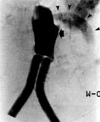 When it comes to flying & supporting all your favorites, we've got you covered. Rupture Of A Dacron Aortic Prosthesis Into The Jejunum Journal Of Vascular Surgery