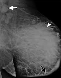 Tumor grade describes how abnormal tumor cells and tissue look under a microscope. What Radiologists Need To Know About Diagnosis And Treatment Of Inflammatory Breast Cancer A Multidisciplinary Approach Radiographics