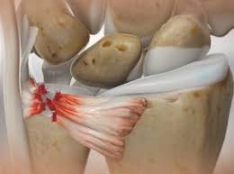 Image result for Triangular Fibrocartilage Complex Injury
