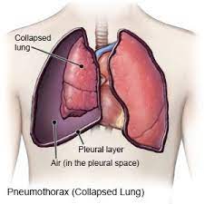 It may occur spontaneously without a known cause, often in healthy people. Spontaneous Pneumothorax Aftercare Instructions What You Need To Know
