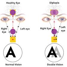 Image result for Diplopia