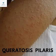 Alma Depilacion Definitiva Seguramente Has Notado Estos Granitos Rojos Ya Sea En Tus Brazos O Piernas O Incluso Espalda O Muslos De Alguien Se Llama Queratosis Pilar La Queratosis Pilar