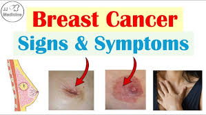 Image result for Cancer Symptom