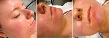 Cảnh báo tác hại sau điều trị laser, peel có thể bạn chưa biết