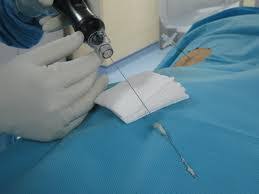 Tratament Minim Invaziv In Hernia De Disc Nucleoplastie Percutana Drbendo Ro