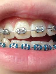 Some patients experience irritation on the inner cheeks, lips and gums when wearing braces. Orthodontic Braces May Cause Scoliosis