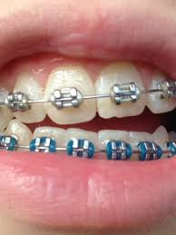 If you have sore spots caused by rubbing, placing an ice cube in that area may help relieve the tenderness by numbing it. Orthodontic Braces May Cause Scoliosis