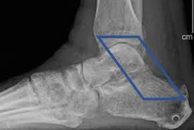 Check spelling or type a new query. Ankle Medial Flexor Retinaculum Avulsion Fracture Sciencedirect