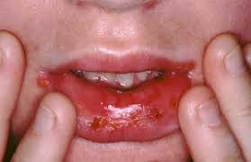Sometimes, too, sores appear on the tongue or face. Hsv Type 1 Herpes Simplex Virus Type 1 Cold Sores Or Fever Blisters Information Treatment Product Reviews