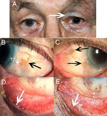 Image result for melanosis sclera