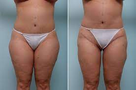 Pin On Thigh Lift