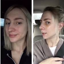 Nose Job Surgery Recovery Cast Removal Two Week Post Op Reveal Until The Very Trend Nose Job Recovery Rhinoplasty Nose Jobs Nose Job