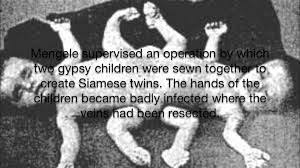 Mengele Sewing Two Romany Children Together To Make Siamese Twins Twins Conjoined Twins Children