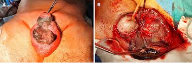 It commonly occurs in older men, but it can also occur in women and children. Management Protocol For Fournier S Gangrene In Sanitary Regime Caused By Sars Cov 2 Pandemic A Case Report